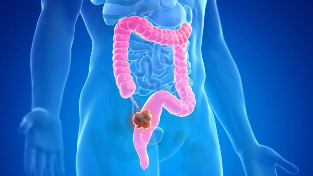 Colorectal Cancer