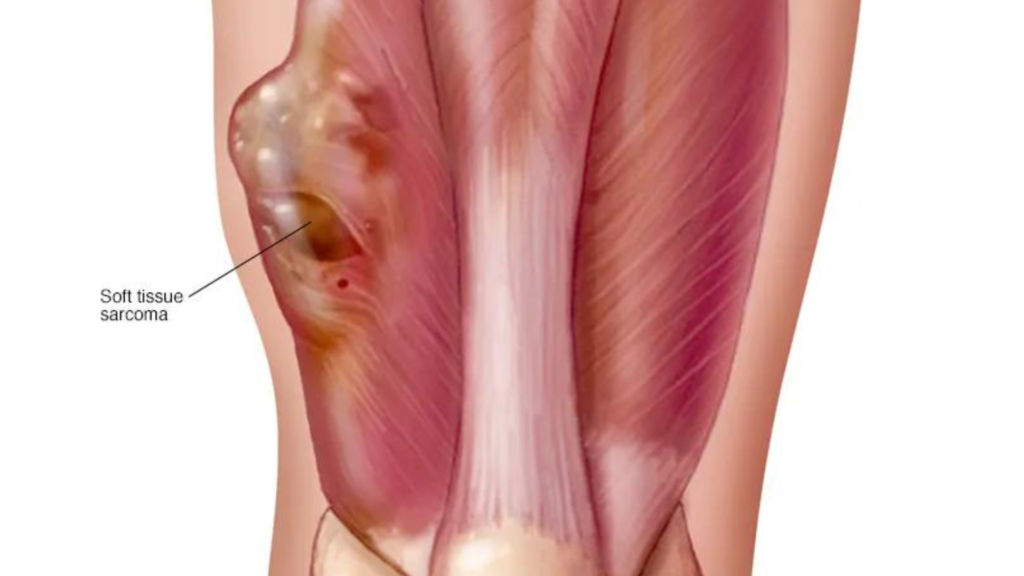 Bone and Soft Tissue Sarcomas