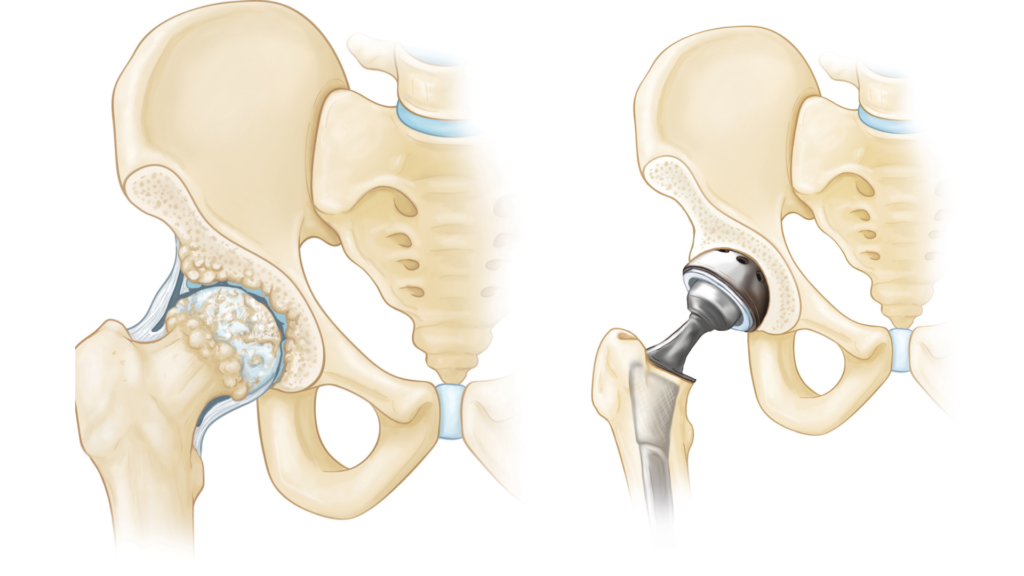 Joint Replacement Surgery