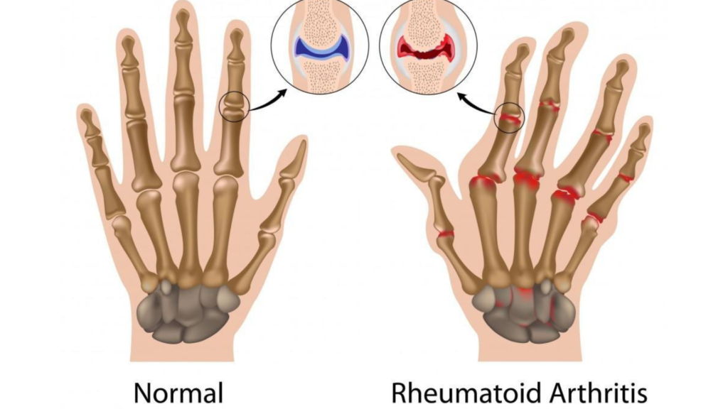 Rheumatoid Arthritis