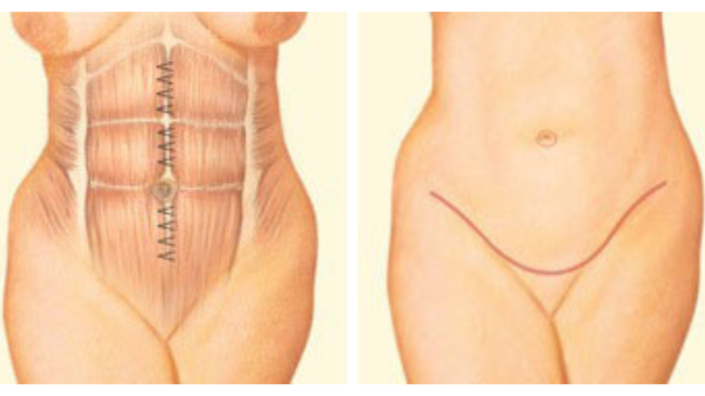 Tummy Tuck Abdominoplasty