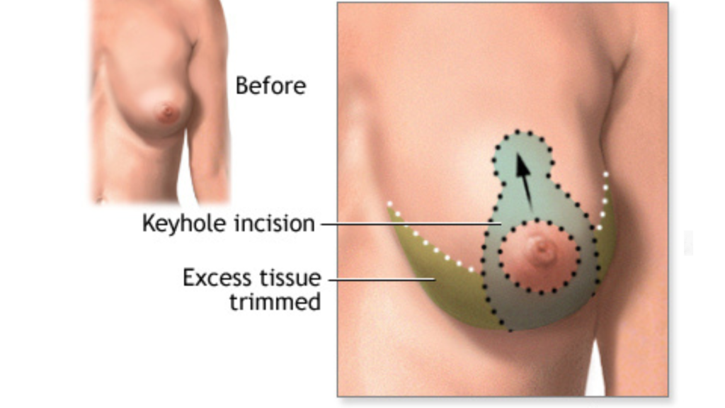 Breast Lift Mastopexy