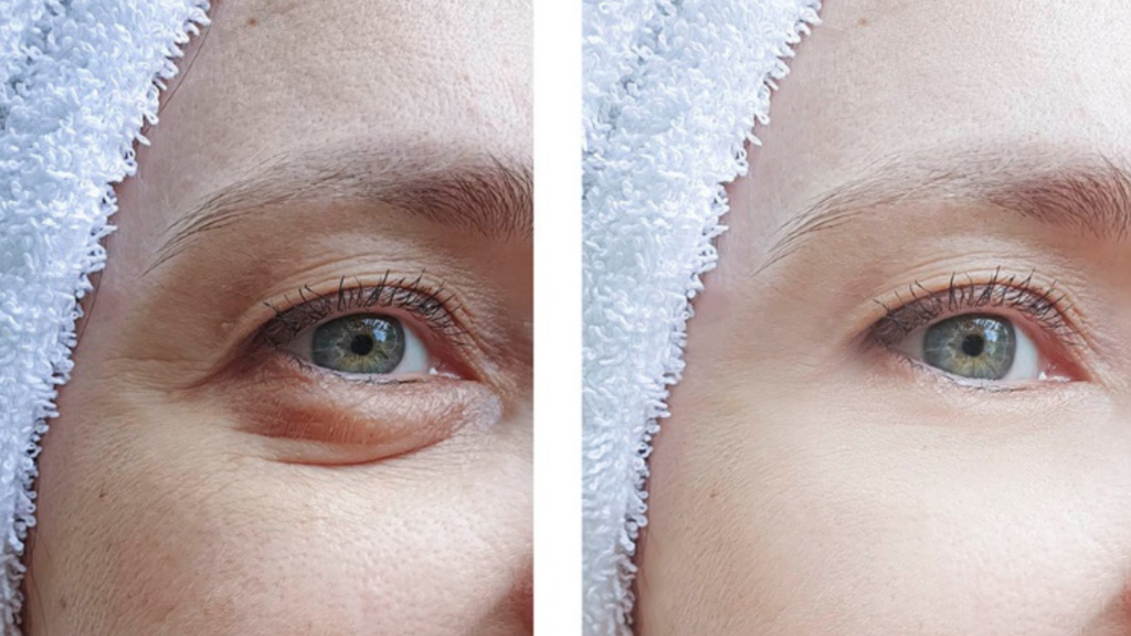 Eyelid Surgery Blepharoplasty