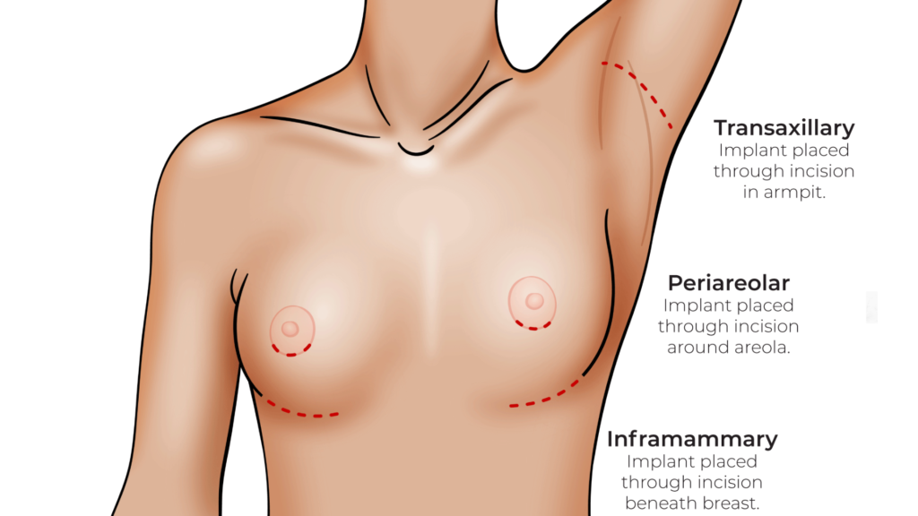 Breast Augmentation